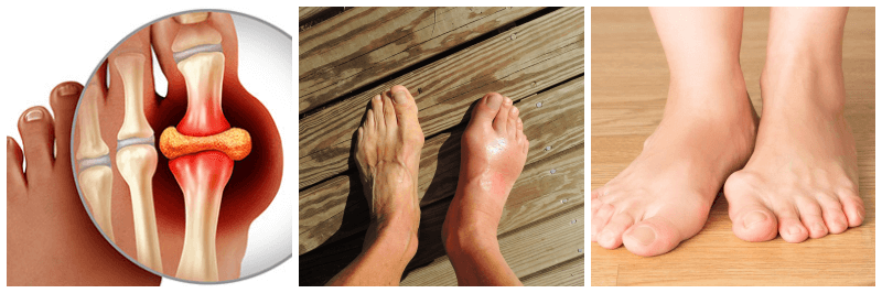 통풍 관련 사진 3개