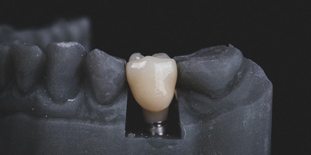 울산-남구-임플란트-치과-가격-비용-싼-곳,저렴한-곳,잘하는-곳,유명한-곳-BEST20-추천21