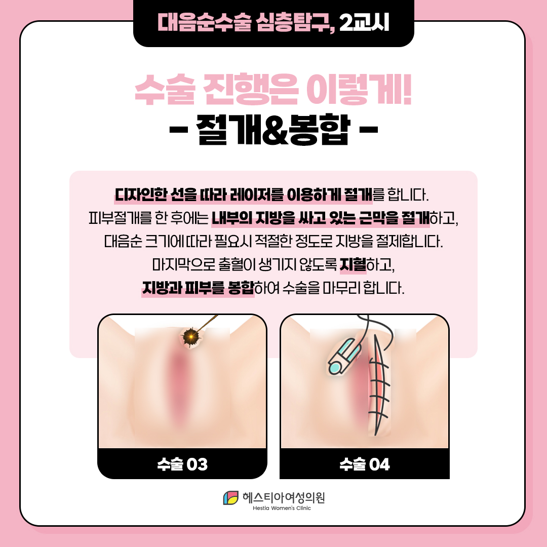 대음순수술 수술 진행