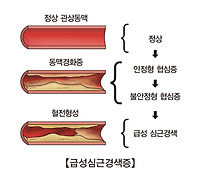 심근경색 전조증상