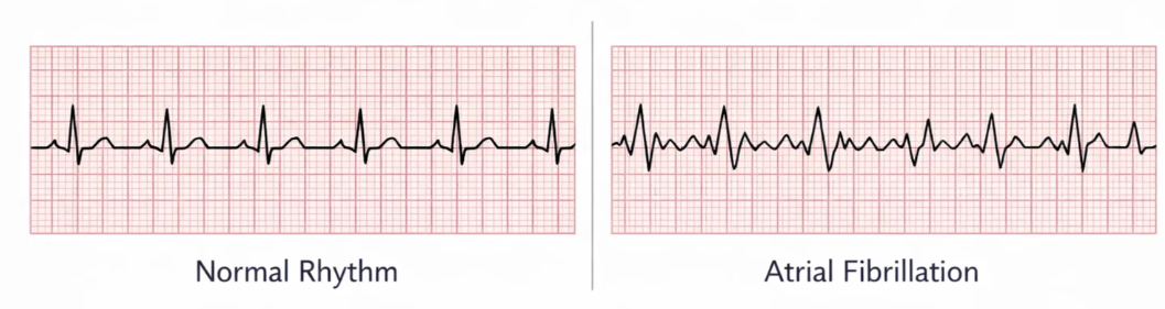 정상 심장 리듬과 심방세동(Atrial Fibrillation) 심전도 파형 비교