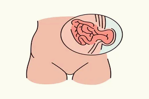 탈장-증세