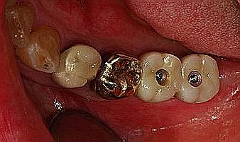 임플란트 가격비교