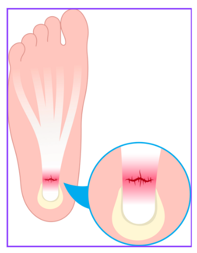 족저근막염 증상 자가 치료법 깔창 선택 방법