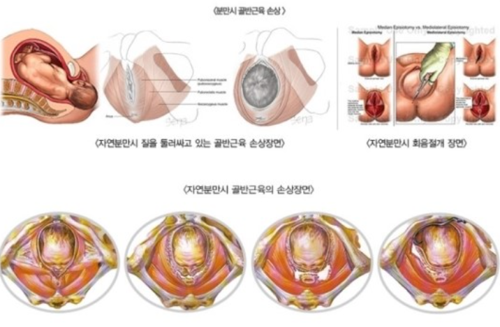 질이완증 / 질 이완 증상, 노화일까? / 질이완증 체크리스트 / 방치하면 생기는 문제와 해결 방법