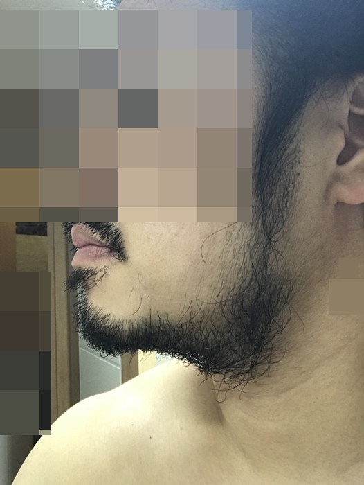 미녹시딜 수염 6개월차 좌측 턱 라인 변화, 진해진 친커튼 수염과 굵어진 목 아래 수염 밀도
