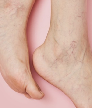 하지정맥류-수술비용