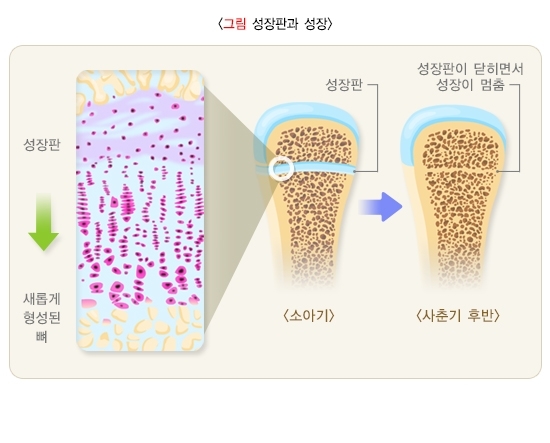 성장판과 성장