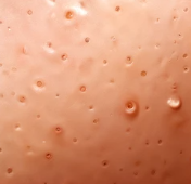 여름철 모공 넓어지는 원인 관련 사진