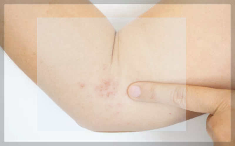 팔 수두 대상 포진 바이러스