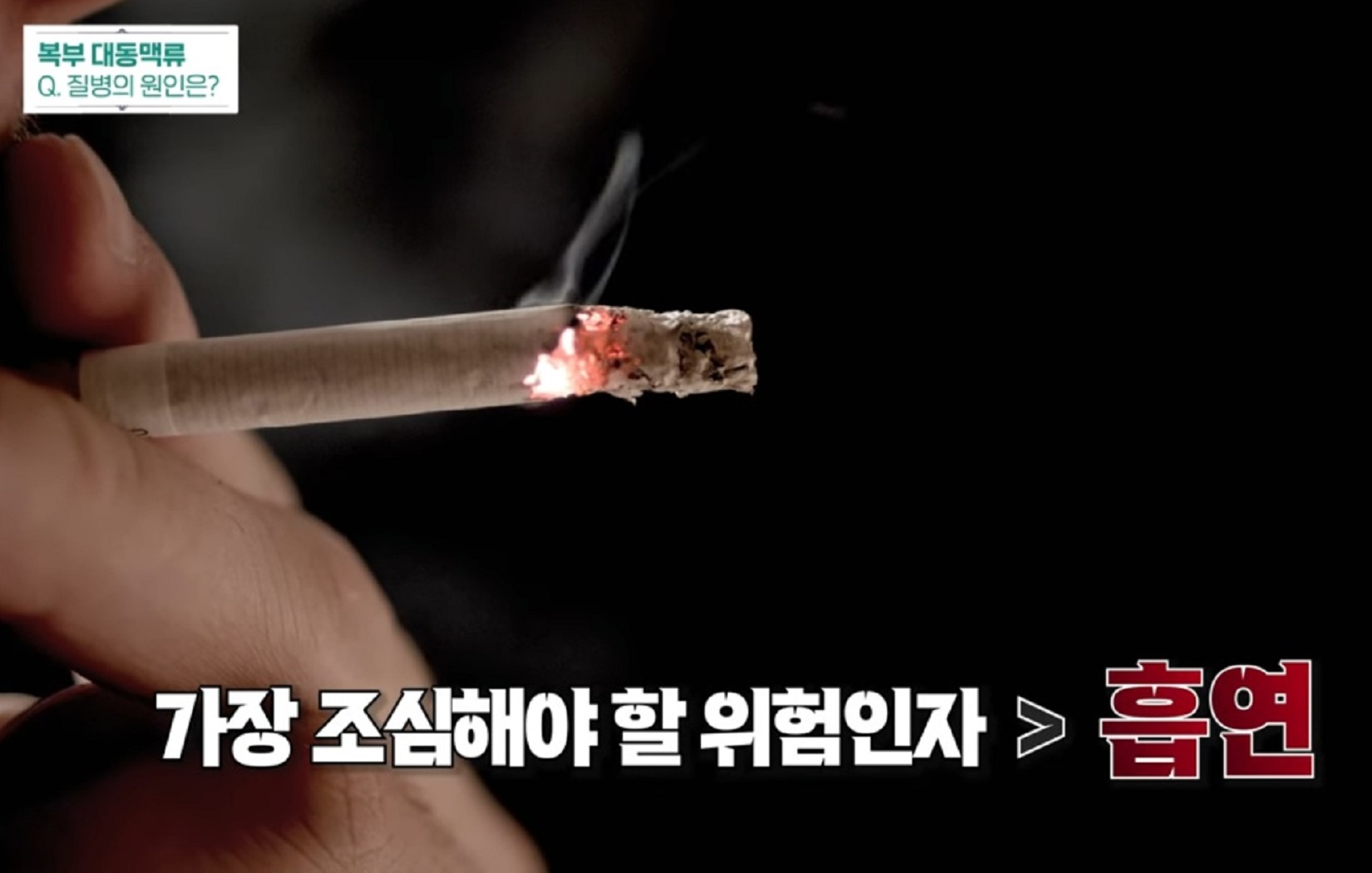 EBS-명의-복부대동맥-원인