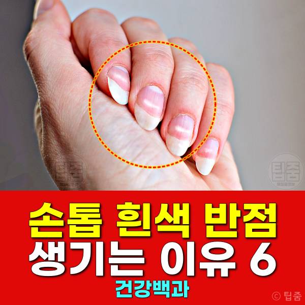손톱 하얀 반점 손톱흰반점 손톱흰색가로줄 원인
