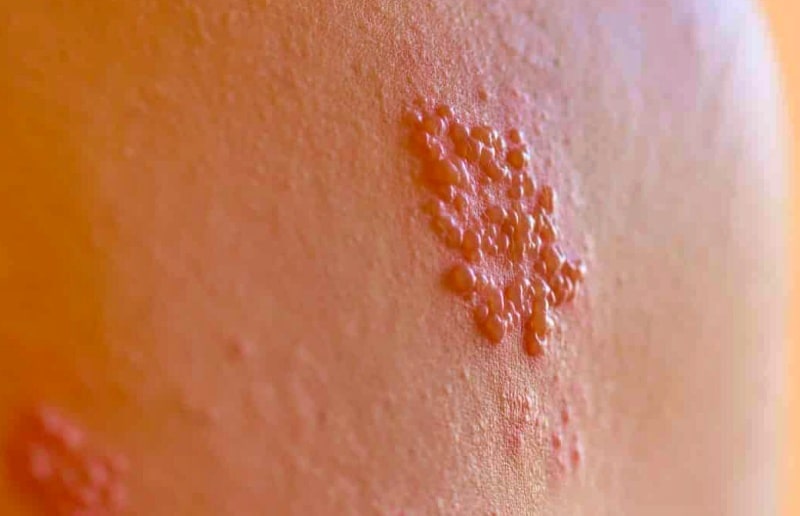 대상포진-치료방법-수포관리