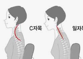 거북목
