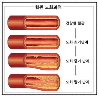  혈관의 노화 과정