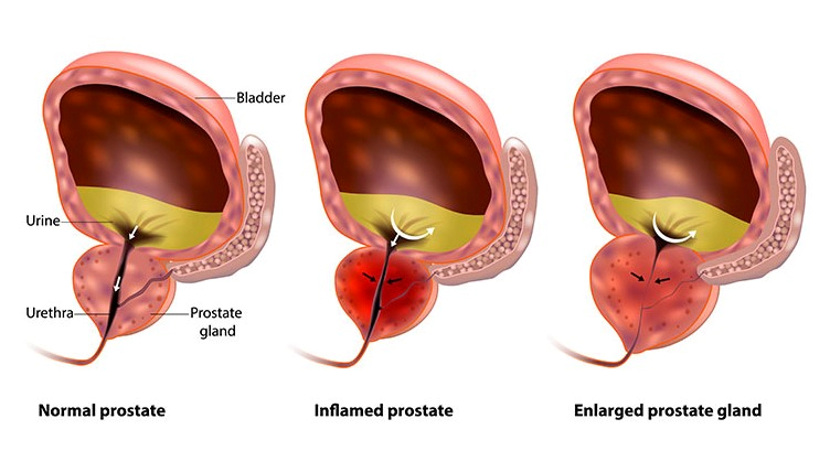 전립선 비대증 증상 발기부전