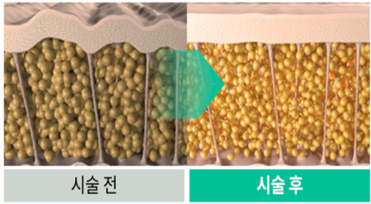 온다리프팅 6