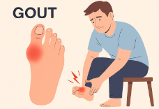 통풍 초기 증상
