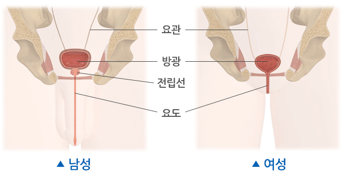 방광염