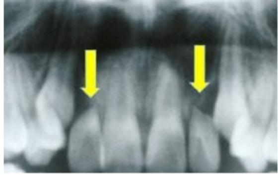 치아교정 부작용
