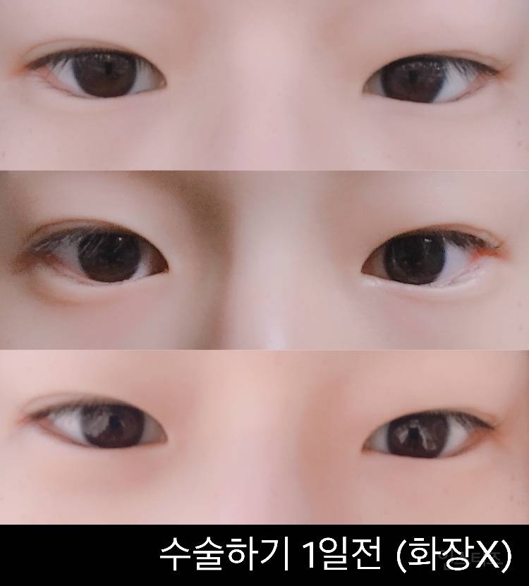 안검내반수술 후기