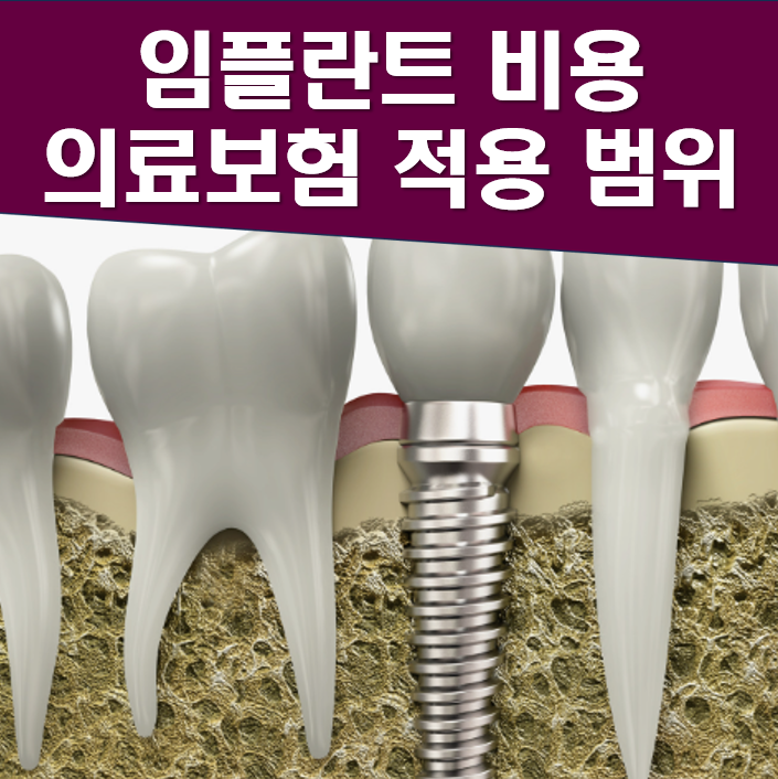 임플란트 가격 및 의료보험 적용대상 완벽가이드 (2024)