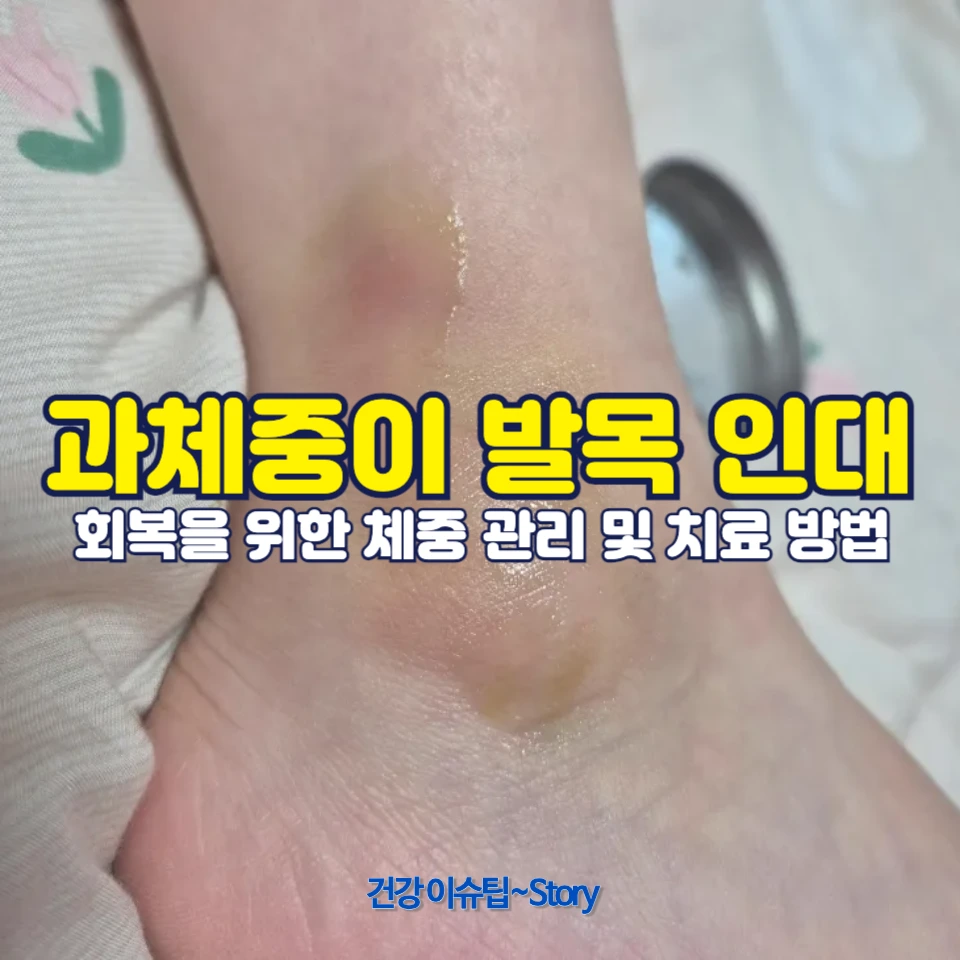 과체중이 발목 인대 파열 회복에 미치는 영향