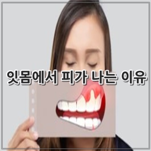 잇몸에서 피가 나는 이유