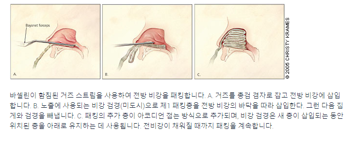 전방비강패킹