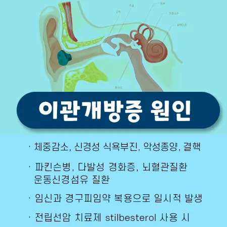 아이유 이관개방증