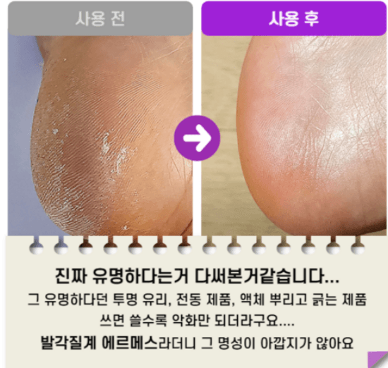 케틀럿 스톤 발각질제거기