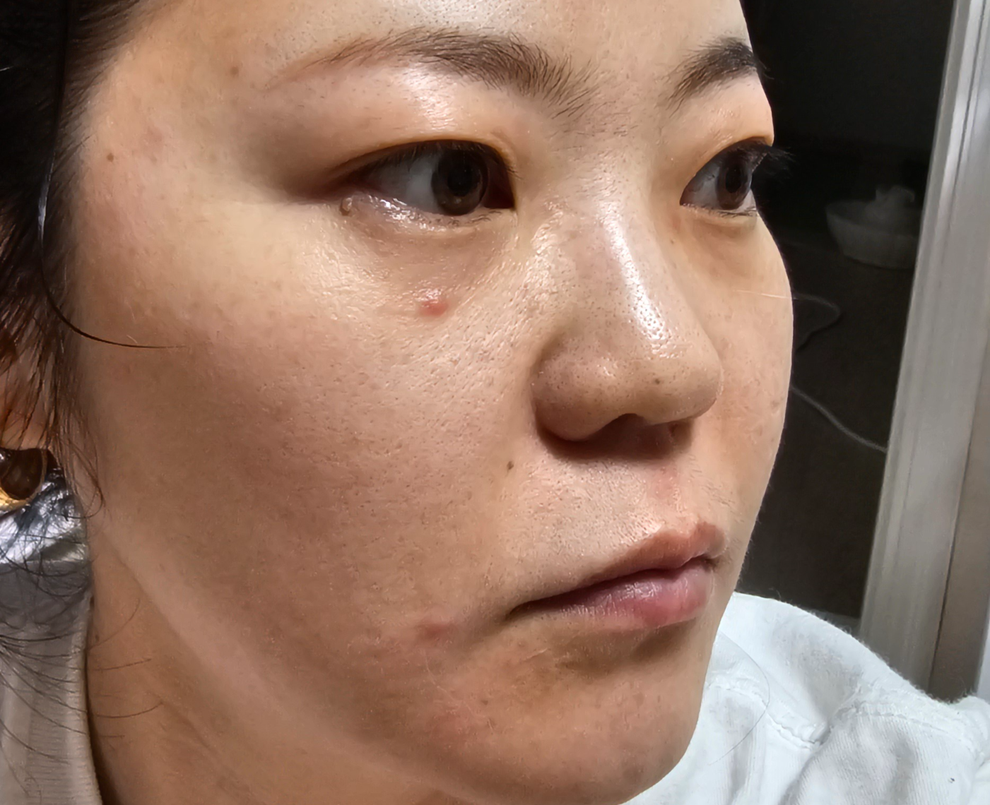 세포랩 사용 전 피부 상태