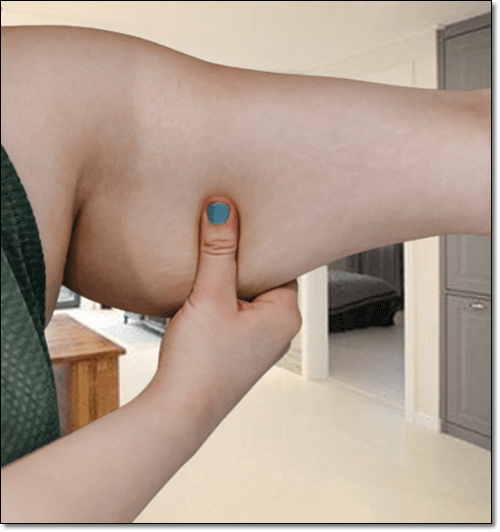 셀룰라이트 없애는 방법