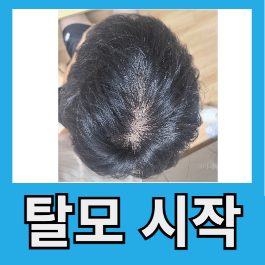 "30대 온 탈모"