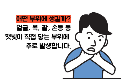 햇빛 알레르기 증상