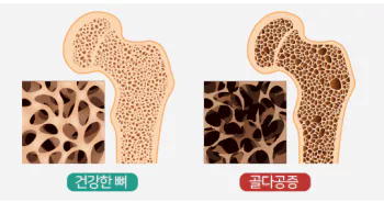 골다공증-예방