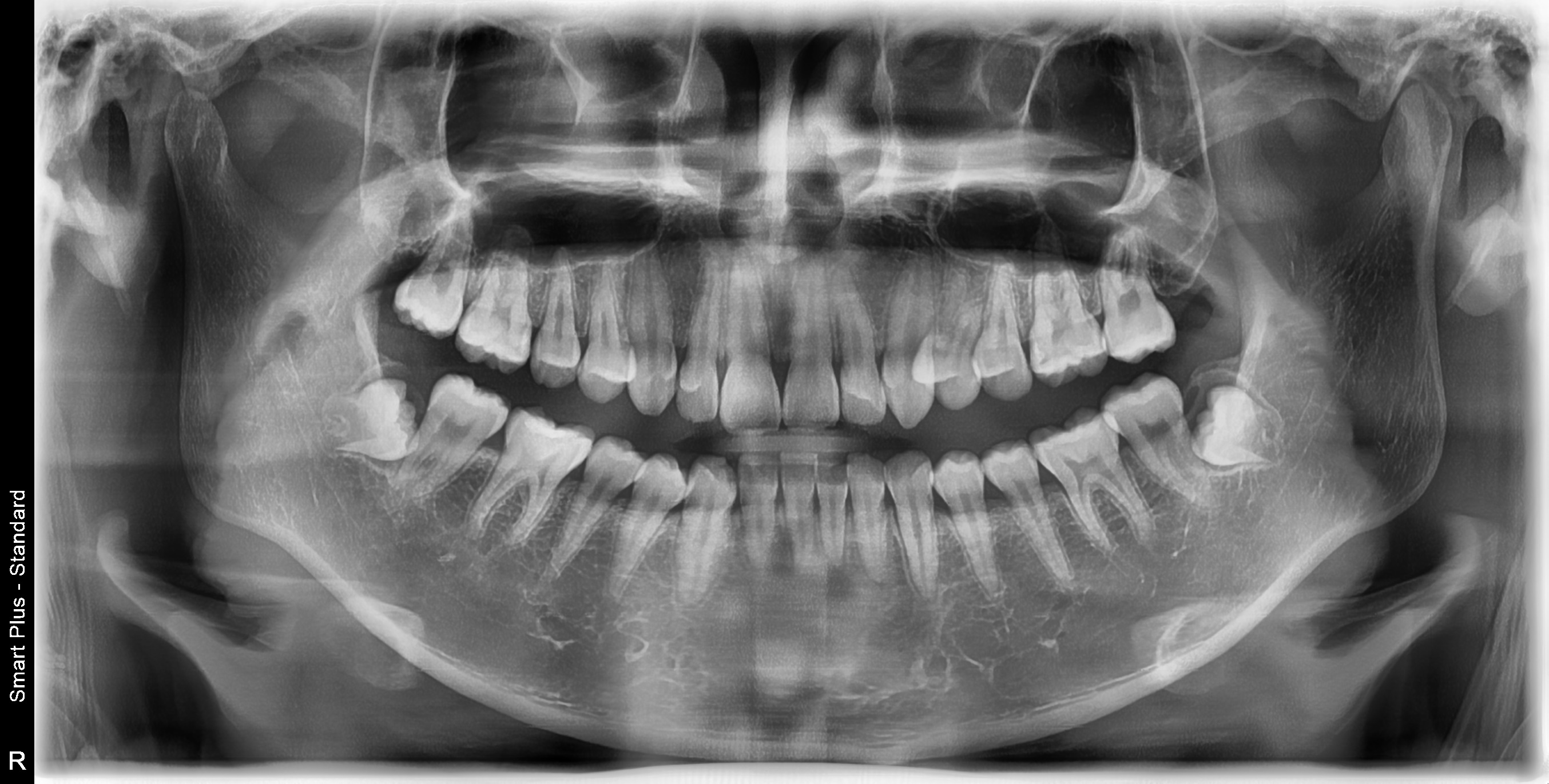 부정교합 가위교합 과개교합 치아교정 후기3