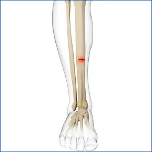 정강이뼈 피로골절