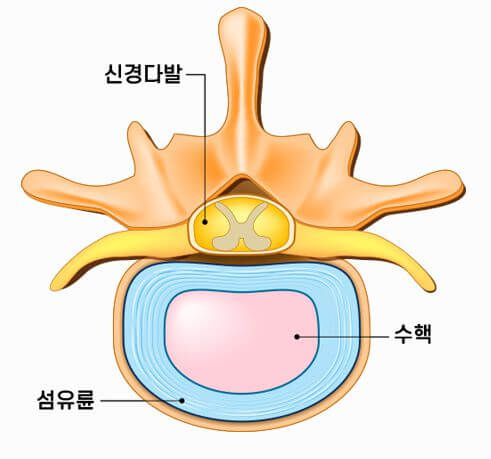 허리디스크란