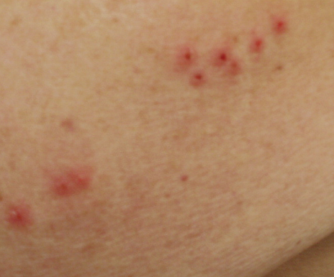 빈대-물린-자국