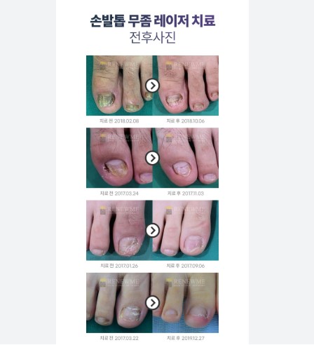 손발톱 무좀