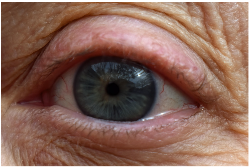 비루관 폐쇄란 무엇인가? – 눈 건강을 위협하는 숨은 문제, 원인부터 치료까지