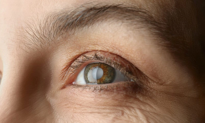 노안 백내장 수술 비용