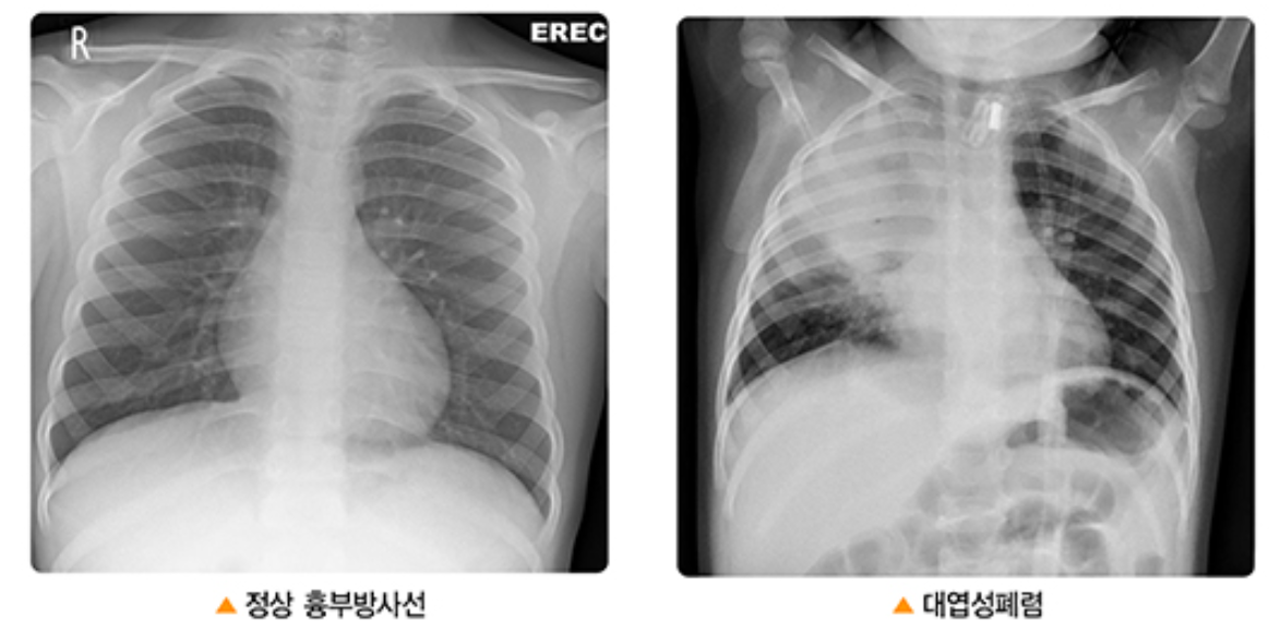 린이 폐렴