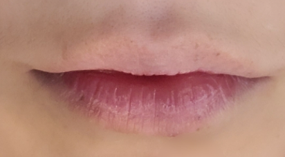 인중 축소 수술 후기