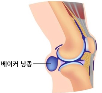 베이커낭종 2