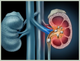 요로 결석의 원인