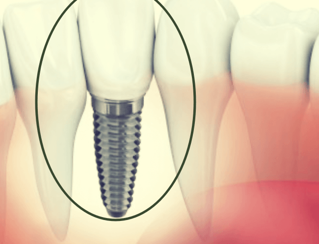 임플란트-고정체의-모습