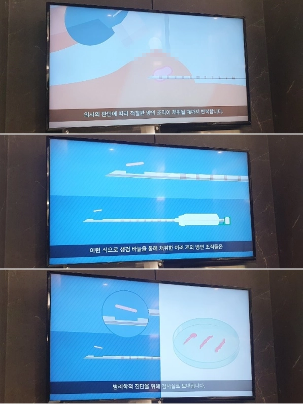 TV에서-유방조직채취과정-보여줌