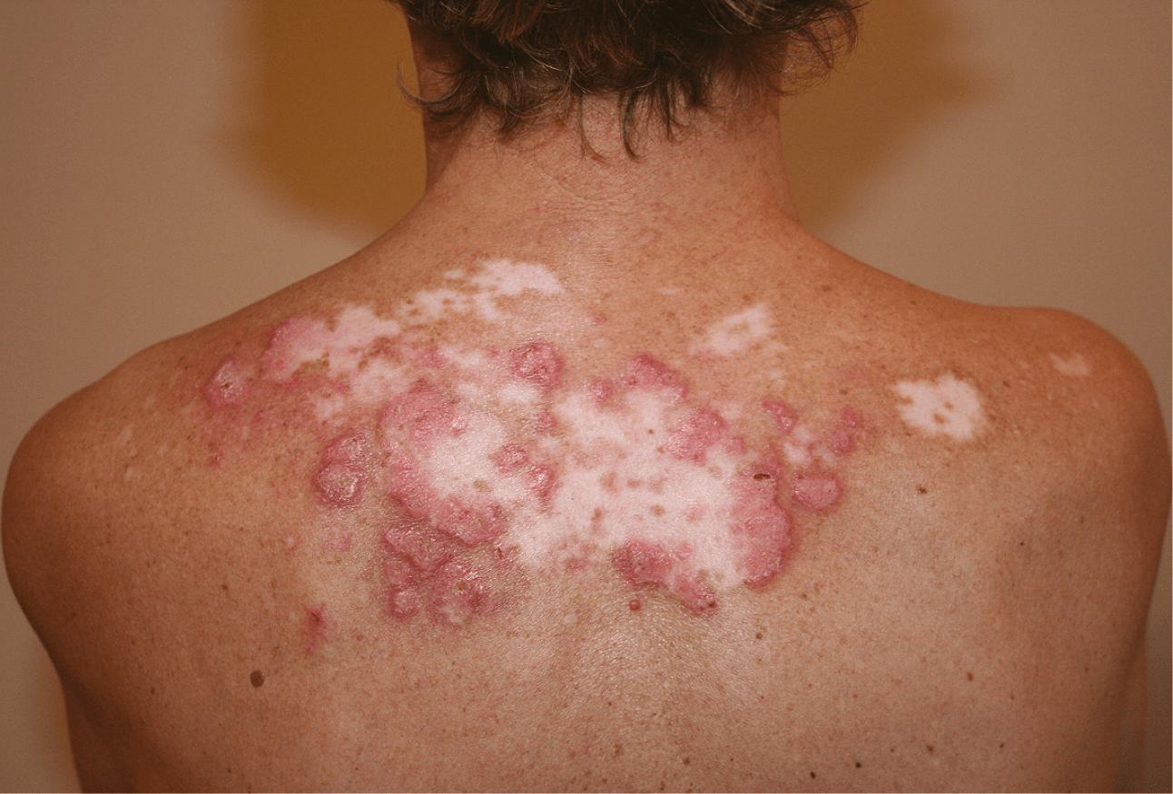 원형-홍반성-루프스